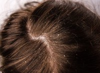 Homeopathic Integrative Care for Persistent Dandruff